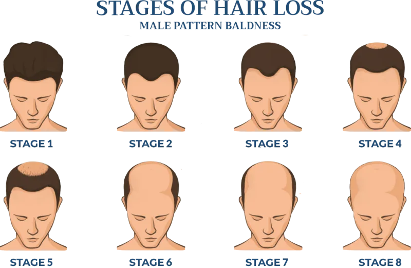 A chart of the eight stages of male pattern baldness, from a full head of hair to a bald crown