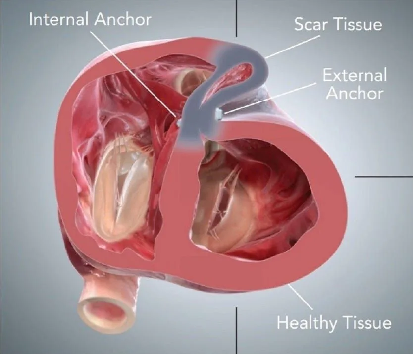 A cross-section of the heart with a band of scar tissue marked between areas of healthy tissue